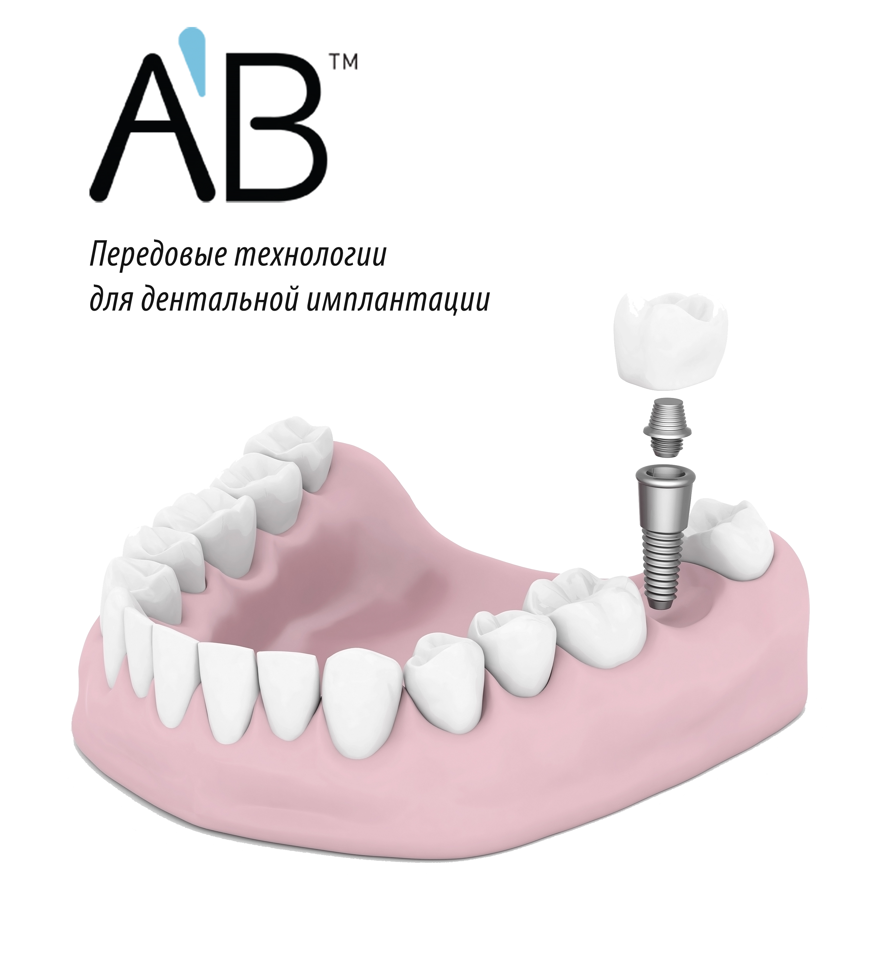 Импланты AB Dental Томск Павлова стоматология специалисты томск